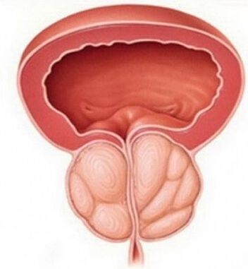 Prostatitis - inflammation of the prostate gland