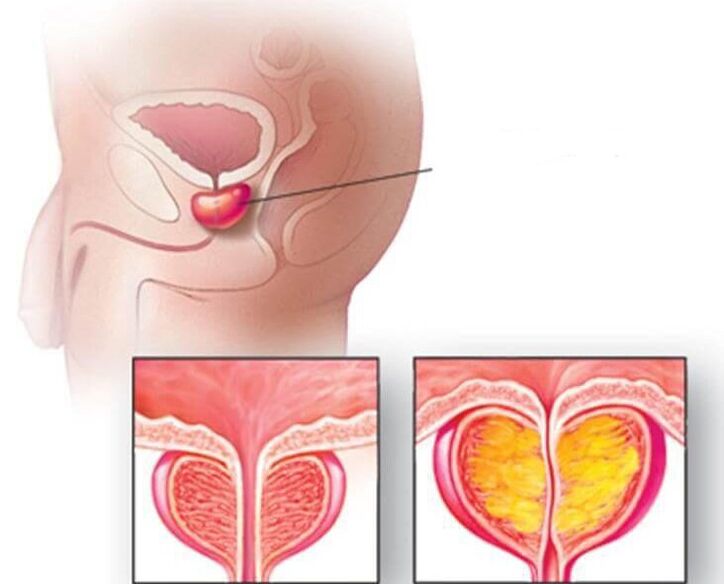 Location of the prostate gland, normal and enlarged prostate in chronic prostatitis
