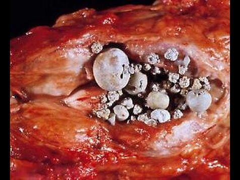 Chalcolithic prostatitis